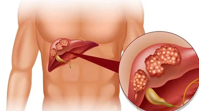Ảnh hưởng của rối loạn chuyển hoá đến chức năng gan