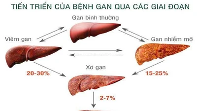 Cảnh báo bệnh lý gan nhiễm mỡ không do rượu ở người trẻ