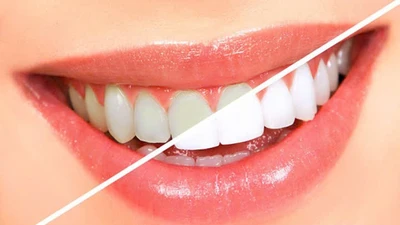 Lạm dụng tẩy trắng răng tại nhà, hại nhiều hơn lợi