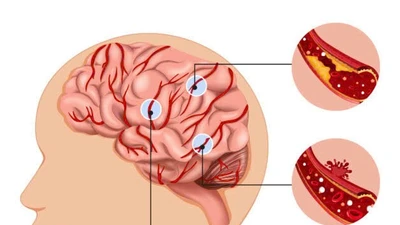 Hướng dẫn xử lý đúng khi người thân tai biến mạch máu não
