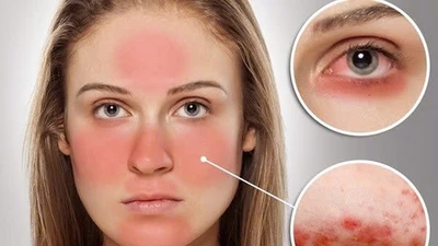 Nhận biết dấu hiệu lupus, phòng ngừa tổn thương nội tạng