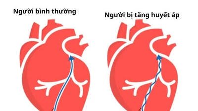 Đừng chủ quan với tăng huyết áp, hiểm họa không dấu hiệu