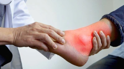 Lý do khiến người trẻ dễ mắc gút