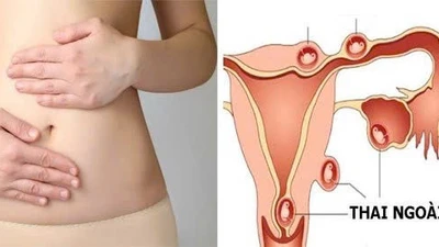 Vì sao chửa ngoài tử cung thường bị nhầm với sảy thai sớm?