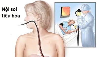 Dấu hiệu cần nội soi tiêu hóa để phát hiện sớm bệnh lý