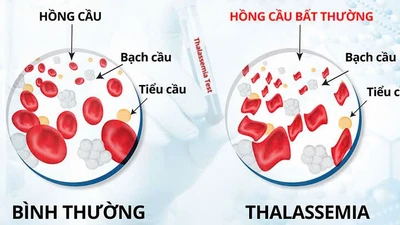 Tan máu bẩm sinh, căn bệnh di truyền nguy hiểm