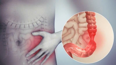 Căn bệnh đường ruột phổ biến, nhiều người không để ý