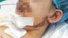 Nhiều trẻ nguy kịch vì tai nạn thương tích ngày hè