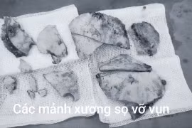 Tông đuôi xe container, nữ bệnh nhân thoát cửa tử sau 5 giờ phẫu thuật