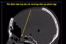 Nội soi nền sọ não vá rò dịch não tủy qua đường mũi