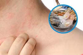Bác sĩ mách cách tránh nguy cơ dị ứng và phản vệ dịp nghỉ lễ 2/9