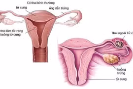 Người phụ nữ 36 tuổi sốc mất máu do chửa ngoài tử cung vỡ
