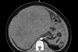 Chưa lập gia đình người phụ nữ phát hiện u sarcoma tử cung nặng gần 9 kg
