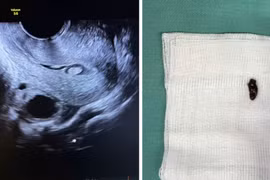 Phát hiện polyp buồng tử cung trước IVF, khi nào cần cắt?