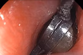 Nuốt nhiều viên nam châm, bé 5 tuổi tổn thương đường tiêu hóa