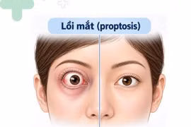 Mắt lồi, mất dần thị lực do khối u nằm sâu sau nhãn cầu