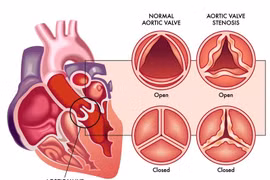 Nặng chân cuối ngày, cảnh giác dấu hiệu bệnh van tim