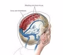 Ai có nguy cơ mắc huyết khối tĩnh mạch não?