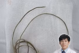 Lấy dị vật trong bàng quang cho nam sinh 16 tuổi