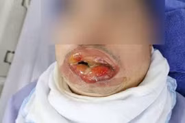 Người đàn ông bị bỏng nặng vùng miệng do xịt khí lạnh chữa bỏng