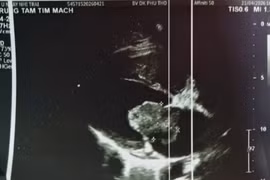 U nhầy tim- thủ phạm thầm lặng gây đột quỵ ở người trẻ