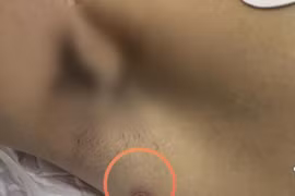 Sốt cao tự điều trị, người đàn ông suy đa tạng nguy kịch 