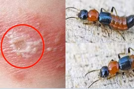 Sai lầm phổ biến khi xử trí kiến ba khoang gây tổn thương nặng thêm