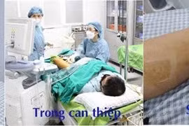 Suy giãn tĩnh mạch vì mỗi ngày đứng liên tục 8 – 12 giờ