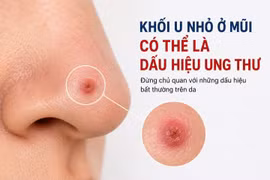 Phát hiện sớm ung thư da từ mụn nhỏ trên mũi 