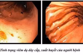 Không tái khám, tự mua thuốc theo đơn cũ, người bệnh cấp cứu vì loét hành tá tràng