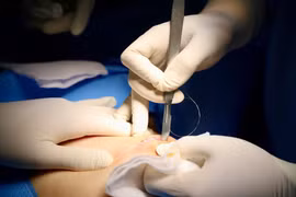 Công nghệ định vị không dây giúp phát hiện, xử lý tổn thương vú siêu nhỏ