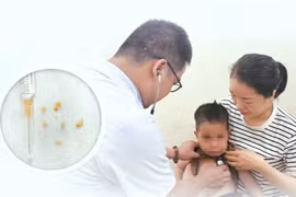 Cứu bé trai 2 tuổi hóc hạt lạc, bít gần kín hai phế quản