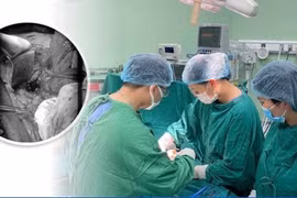 Mang thai sau sinh mổ 12 tháng, sản phụ vỡ tử cung, thai lưu trong ổ bụng