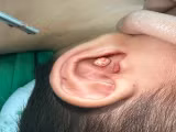 Gây mê lấy sỏi trong tai trẻ hơn 5 tuổi