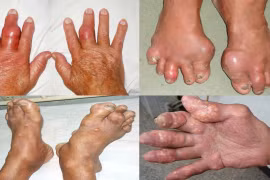 Acid uric cao chưa chắc mắc gút, nhưng 5 sai lầm khiến bệnh tiến triển