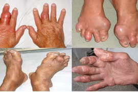 Uống thật nhiều nước có 'rửa' được acid uric, hết gout?