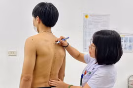 Tưởng đau do vận động quá mức không ngờ viêm cột sống dính khớp