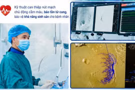 Can thiệp nút mạch cứu người phụ nữ mắc dị dạng mạch tử cung 