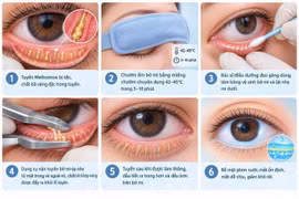 Viêm bờ mi căn bệnh âm thầm giảm chất lượng cuộc sống tuổi trung niên