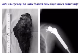 Thay khớp vai đảo ngược, giữ lại cánh tay cho bệnh nhi 14 tuổi ung thư xương