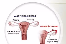 Phát hiện kịp thời ca thai trong và ngoài tử cung hiếm gặp