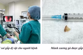 Cảnh báo tình trạng hóc dị vật khi ăn uống, cần biết cách phòng tránh
