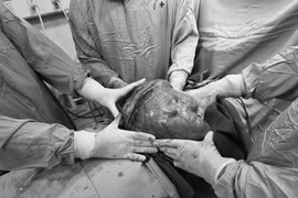 Cô gái 23 tuổi mang khối u xơ tử cung nặng 6 kg trong ổ bụng