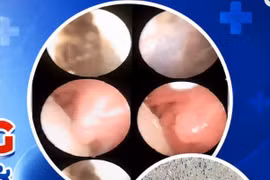 Phẫu thuật cắt bỏ khổi u cho bé sơ sinh mắc dị tật đường thở cực hiếm