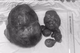 Bóc tách thành công khối u ổ bụng nặng gần 8kg sau 6 tháng tự dùng thuốc nam