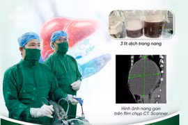 Nang gan lành tính thường bị bỏ qua nhưng có thể đe dọa tính mạng