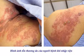 Tưởng zona ngoài da, cụ ông 78 tuổi bất ngờ mắc viêm màng não
