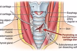 Chạy đua từng phút cứu chàng trai đứt rách nhiều vòng khí quản
