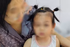 Bé 22 tháng tuổi bị chó cắn tổn thương nghiêm trọng vùng mặt