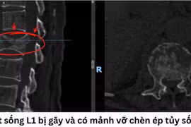 Ngã từ mái nhà, người đàn ông suýt liệt vì gãy đốt sống thắt lưng